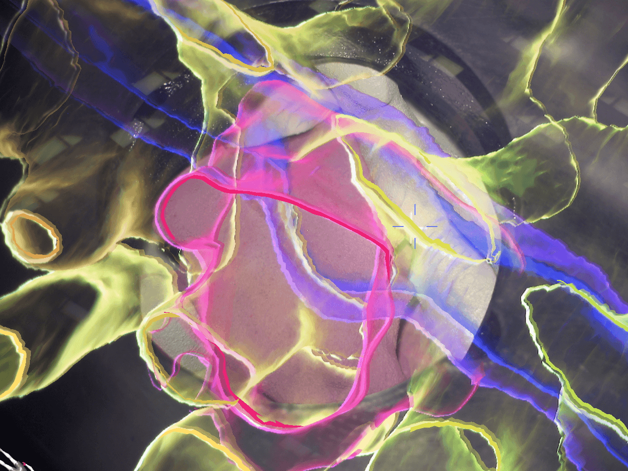 Surgical navigation tumour-resection visualization